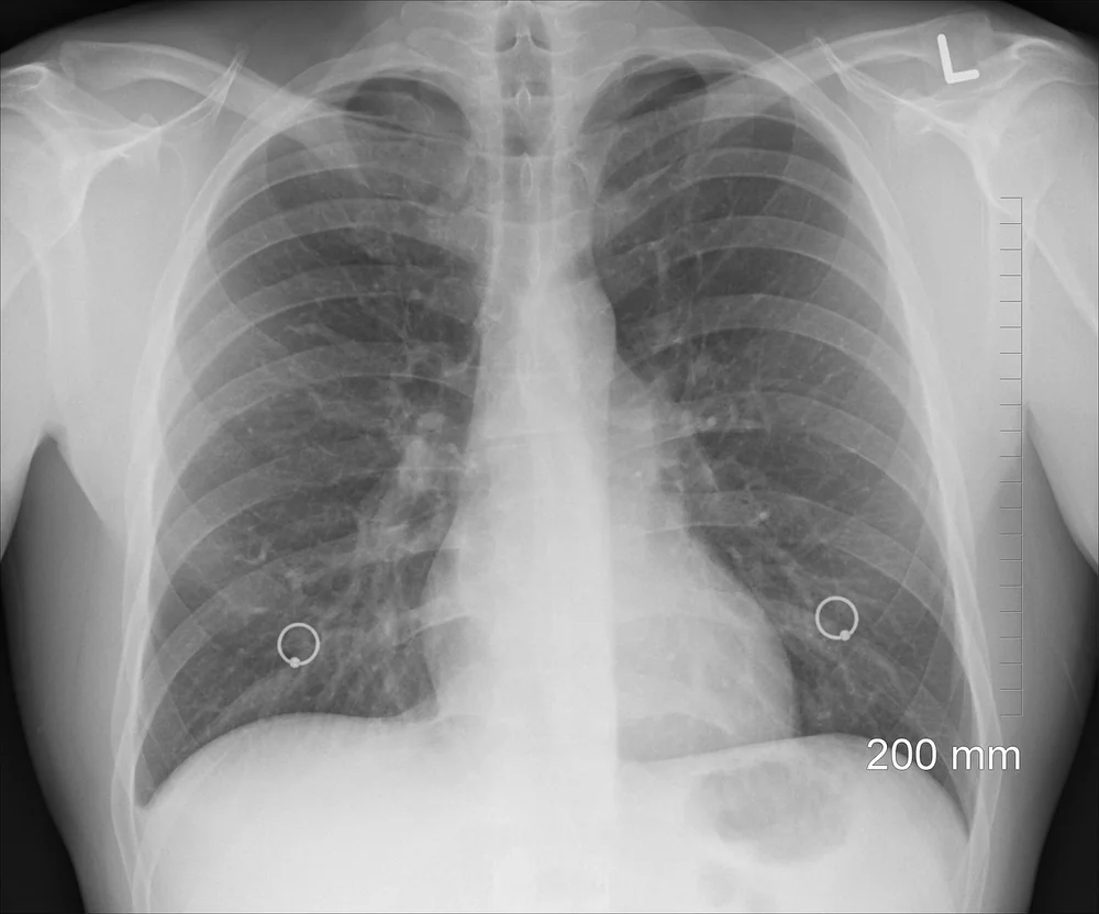 Inspiration for Generative chest xray